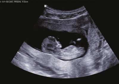 12 weeks fetus with S-Harmonic™