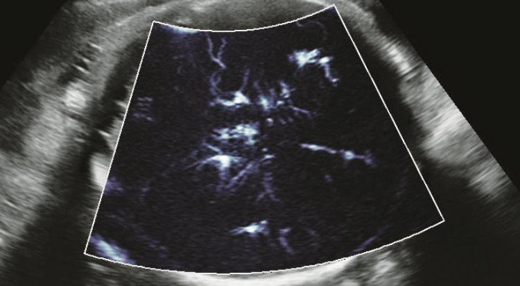 BPD with MV-Flow™ BPD with MV-Flow™