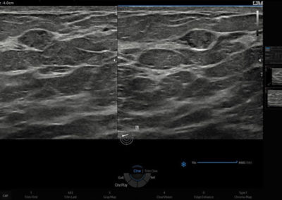 Breast with WideScreen