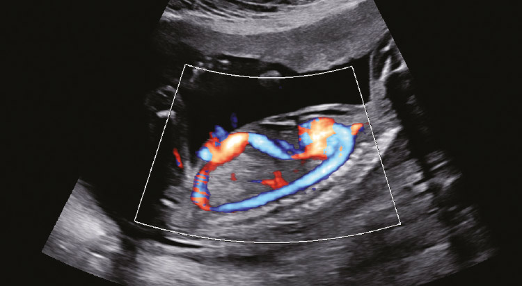 Fetal circulation with S-Flow™ Fetal circulation with S-Flow™