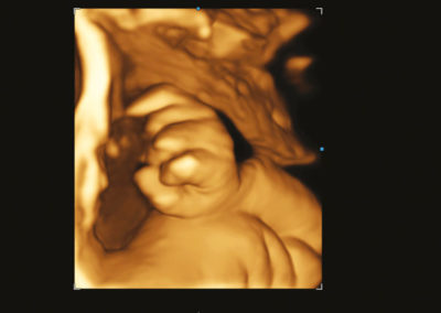 Fetal hand with AmbientLight