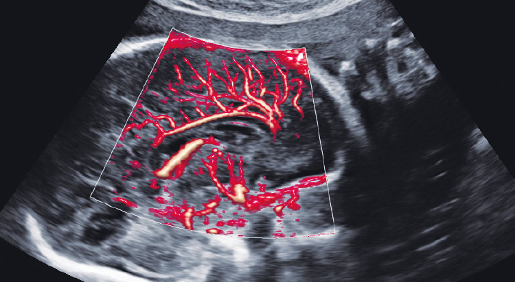 MV-Flow™ with LumiFlow™ (Fetal brain) MV-Flow™ with LumiFlow™ (Fetal brain)